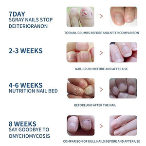 Adesivos para Unhas com Fungos para Reparação de Unhas, Adesivos para Correção de Unhas Encravadas para Unhas Descoloridas e Danificadas, Adesivo para Cuidado das Unhas
